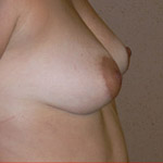 Areolar Reduction - Before And After Pictueres