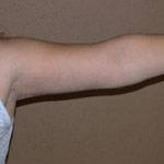 Arm Lift - Before and After Pictures