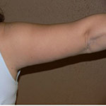 Arm Lift - Before and After Pictures
