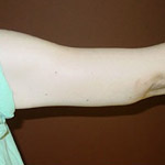 Arm Lift - Before and After Pictures