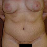 Belt Lipectomy - Before And After Pictueres