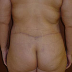 Belt Lipectomy - Before And After Pictueres