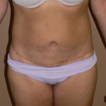 Belt Lipectomy - Before And After Pictueres