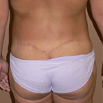 Belt Lipectomy - Before And After Pictueres