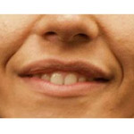 Botox - Before And After Pictueres