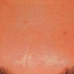 Botox - Before And After Pictueres