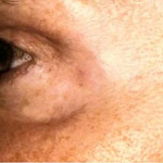 Botox - Before And After Pictueres