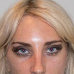 Botox - Before And After Pictueres