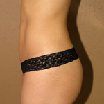 Brazilian Buttock Lift - Before And After Pictueres