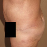 Brazilian Buttock Lift - Before And After Pictueres