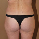 Brazilian Buttock Lift - Before And After Pictueres