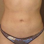Brazilian Buttock Lift - Before And After Pictueres