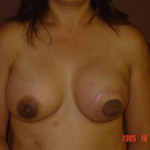 Breast Reconstruction - Before And After Pictueres