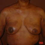 Breast Reconstruction - Before And After Pictueres