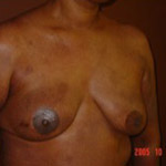 Breast Reconstruction - Before And After Pictueres