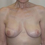 Breast Reconstruction - Before And After Pictueres