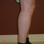 Calf Augmentation - Before And After Pictueres