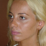 Chin Augmentation - Before And After Pictueres