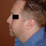 Chin Augmentation - Before And After Pictueres