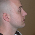 Chin Augmentation - Before And After Pictueres