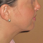 Chin Augmentation - Before And After Pictueres