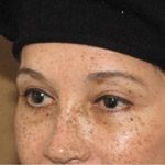 Eyelid Lift Surgery - Before And After Pictueres