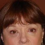 Eyelid Lift Surgery - Before And After Pictueres