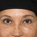 Eyelid Lift Surgery - Before And After Pictueres