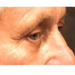 Eyelid Lift Surgery - Before And After Pictueres