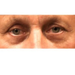 Eyelid Lift Surgery - Before And After Pictueres