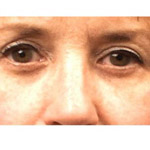 Eyelid Lift Surgery - Before And After Pictueres