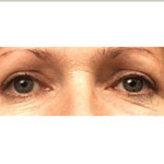 Eyelid Lift Surgery - Before And After Pictueres