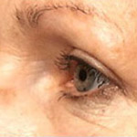 Eyelid Lift Surgery - Before And After Pictueres