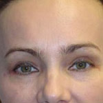 Eyelid Lift Surgery - Before And After Pictueres