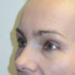 Eyelid Lift Surgery - Before And After Pictueres