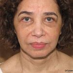Face Lift - Before And After Pictueres