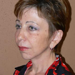 Face Lift - Before And After Pictueres