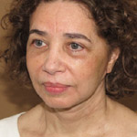 Face Lift - Before And After Pictueres