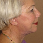 Face Lift - Before And After Pictueres