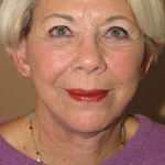 Face Lift - Before And After Pictueres