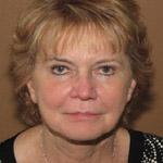 Face Lift - Before And After Pictueres