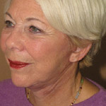 Face Lift - Before And After Pictueres