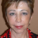 Face Lift - Before And After Pictueres