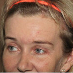 Forehead Brow Lift - Before And After Pictueres