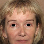 Forehead Brow Lift - Before And After Pictueres