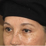 Forehead Brow Lift - Before And After Pictueres