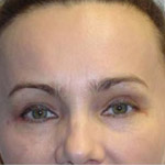 Forehead Brow Lift - Before And After Pictueres