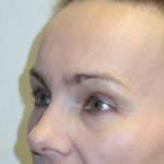Forehead Brow Lift - Before And After Pictueres