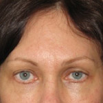 Forehead Brow Lift - Before And After Pictueres
