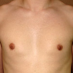 Gynecomastia Correction - Before And After Pictueres